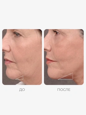 Лифтинг-маска для V-зоны с коллагеном